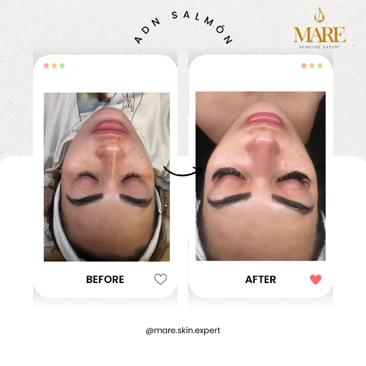 ADN de Salmón – Tratamiento Regenerativo | Mare Perfect Skin