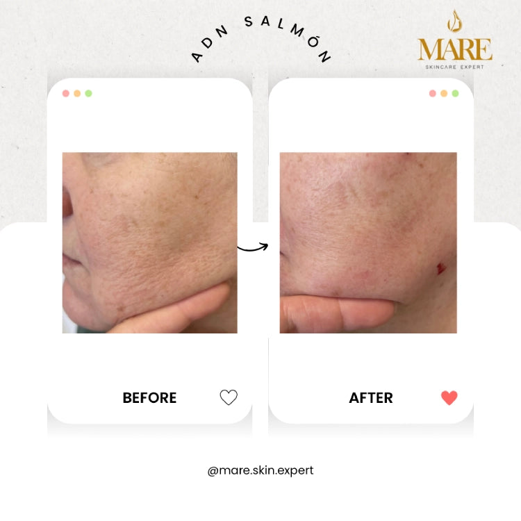 ADN de Salmón – Tratamiento Regenerativo | Mare Perfect Skin