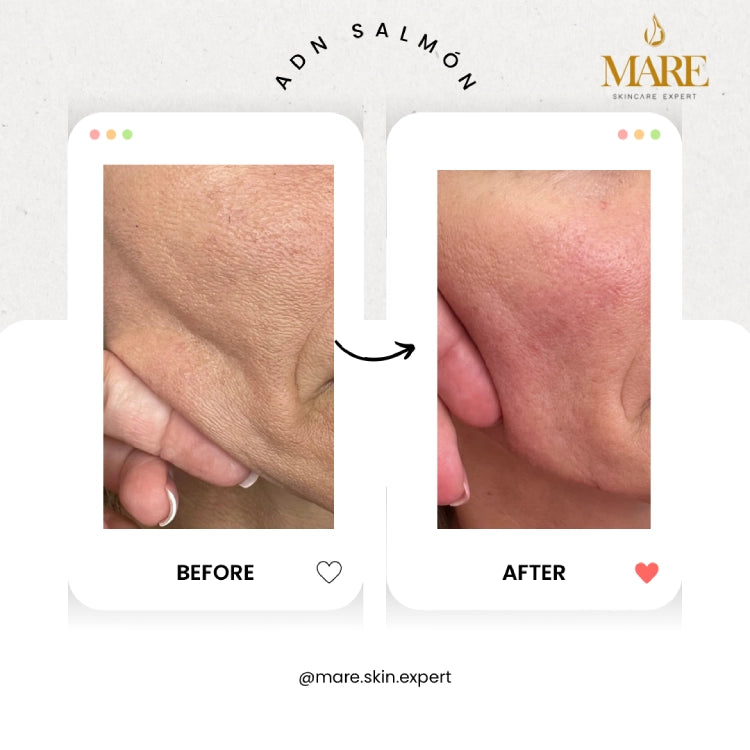 ADN de Salmón – Tratamiento Regenerativo | Mare Perfect Skin