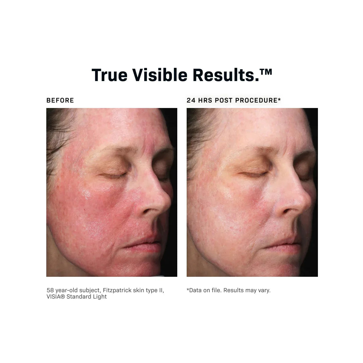 Revision CMT post procedure cream