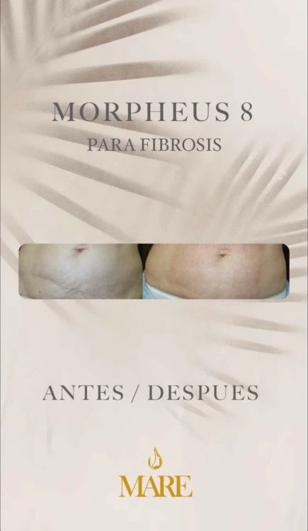 Morpheus8 – Rejuvenecimiento Facial y Corporal | Mare Perfect Skin