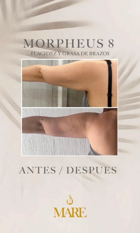Morpheus8 – Rejuvenecimiento Facial y Corporal | Mare Perfect Skin