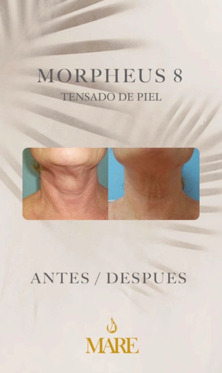 Morpheus8 – Rejuvenecimiento Facial y Corporal | Mare Perfect Skin