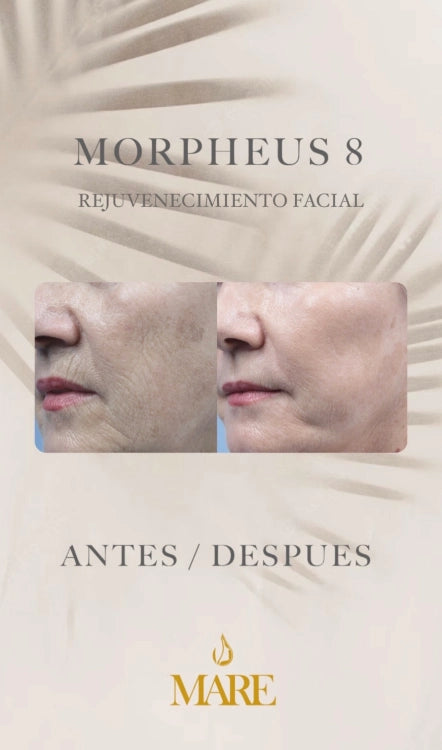 Morpheus8 – Rejuvenecimiento Facial y Corporal | Mare Perfect Skin