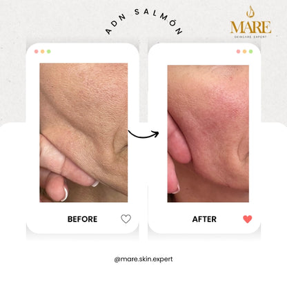 ADN de Salmón – Tratamiento Regenerativo | Mare Perfect Skin