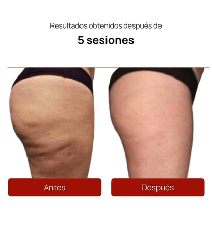 ALIDYA ANTICELULITIS