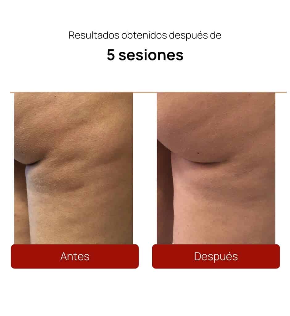 ALIDYA ANTICELULITIS