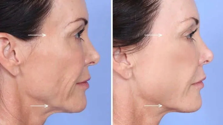 SCULPTRA BIOESTIMULADOR DE COLÁGENO