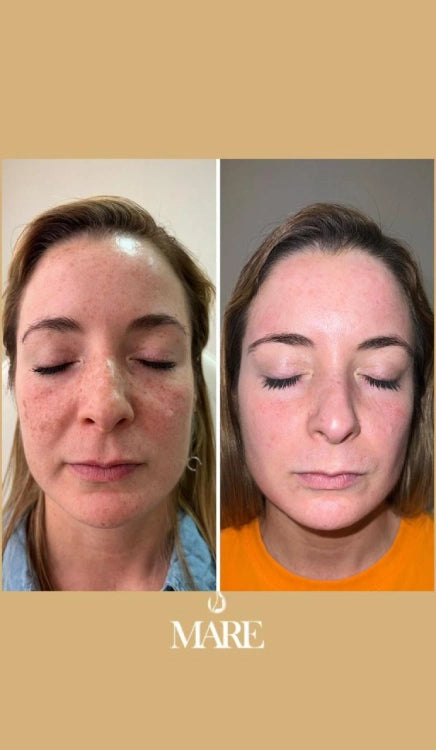 Cosmelan Tratamiento Despigmentante | Mare Perfect Skin