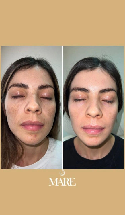 Cosmelan Tratamiento Despigmentante | Mare Perfect Skin