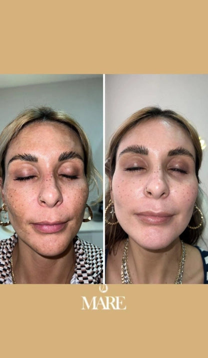 Cosmelan Tratamiento Despigmentante | Mare Perfect Skin