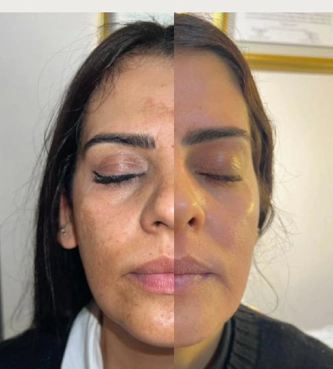 Cosmelan Tratamiento Despigmentante | Mare Perfect Skin