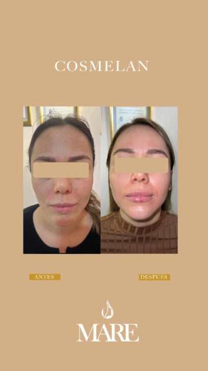 Cosmelan Tratamiento Despigmentante | Mare Perfect Skin