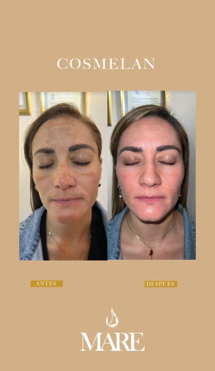 Cosmelan Tratamiento Despigmentante | Mare Perfect Skin
