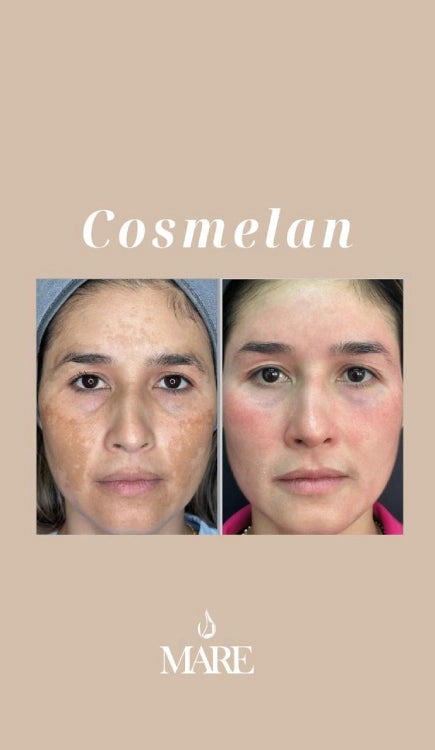 Cosmelan Tratamiento Despigmentante | Mare Perfect Skin