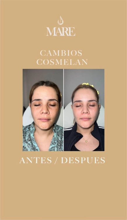 Cosmelan Tratamiento Despigmentante | Mare Perfect Skin