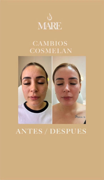 Cosmelan Tratamiento Despigmentante | Mare Perfect Skin