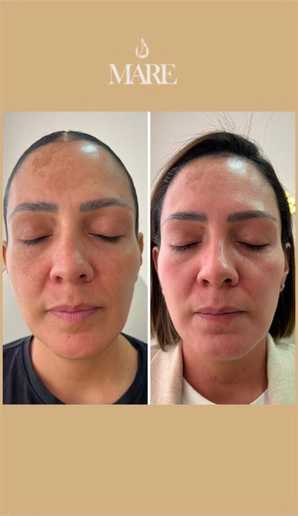 Cosmelan Tratamiento Despigmentante | Mare Perfect Skin