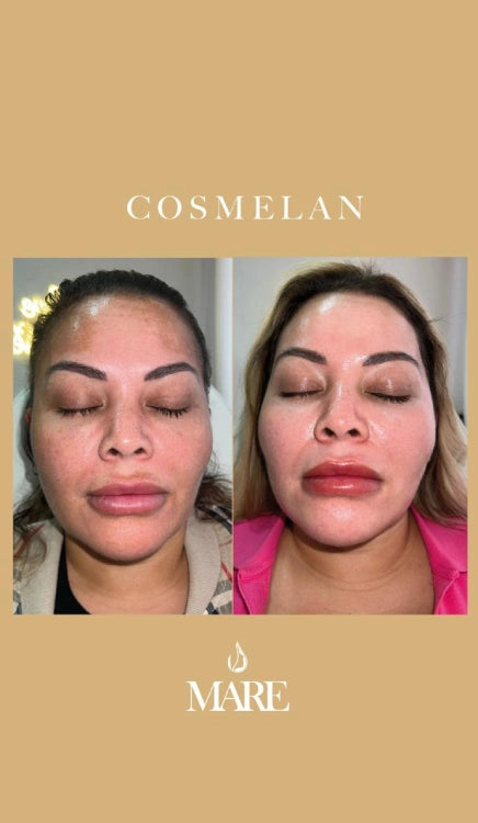 Cosmelan Tratamiento Despigmentante | Mare Perfect Skin
