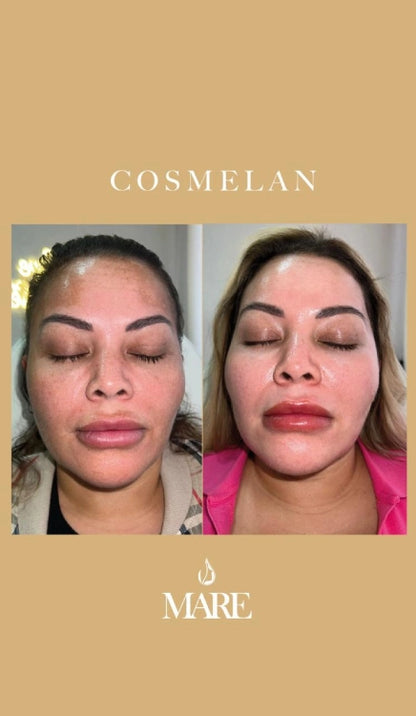Cosmelan Tratamiento Despigmentante | Mare Perfect Skin