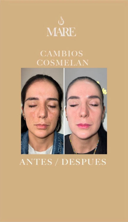 Cosmelan Tratamiento Despigmentante | Mare Perfect Skin