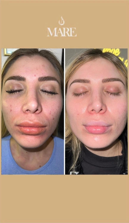 Cosmelan Tratamiento Despigmentante | Mare Perfect Skin