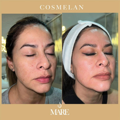 Cosmelan Tratamiento Despigmentante | Mare Perfect Skin