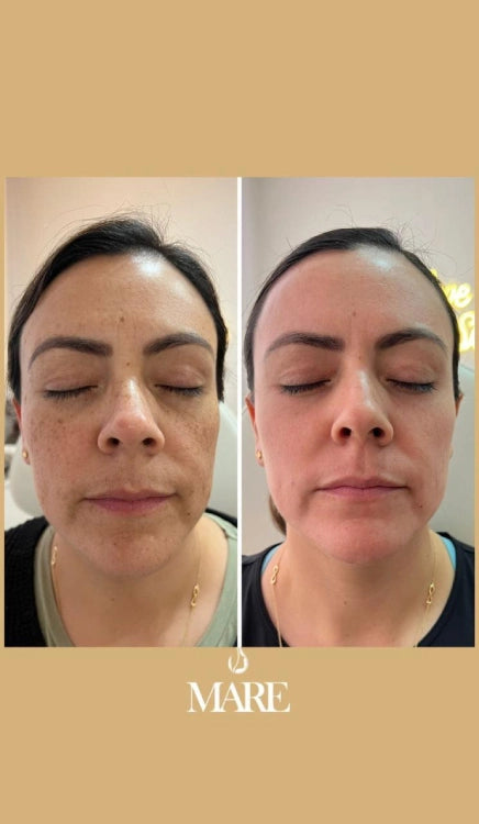 Cosmelan Tratamiento Despigmentante | Mare Perfect Skin
