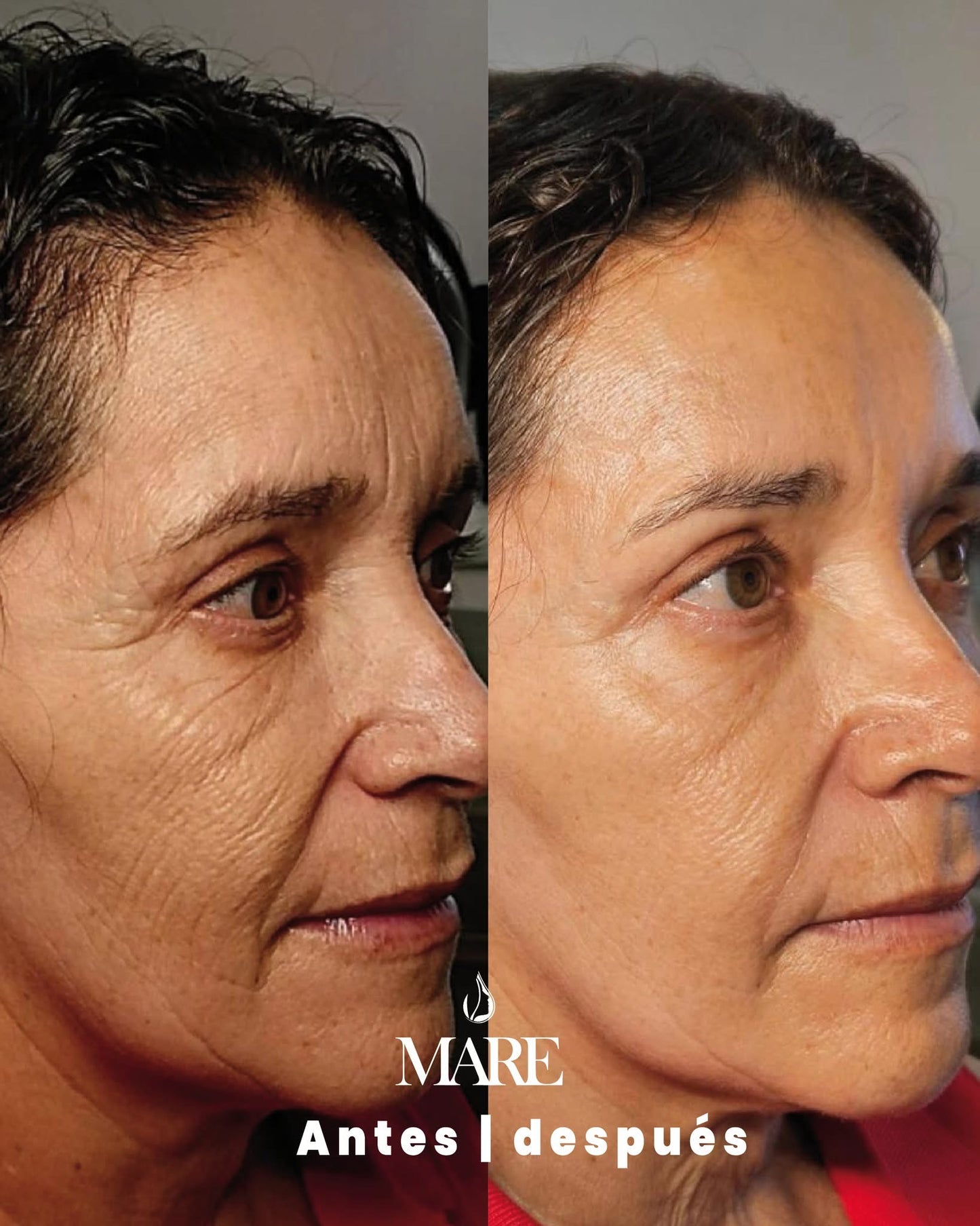 SCULPTRA BIOESTIMULADOR DE COLÁGENO