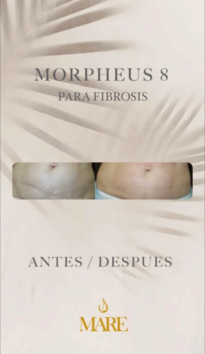 Morpheus8 – Rejuvenecimiento Facial y Corporal | Mare Perfect Skin