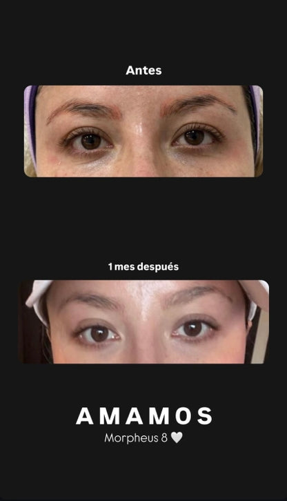 Morpheus8 – Rejuvenecimiento Facial y Corporal | Mare Perfect Skin