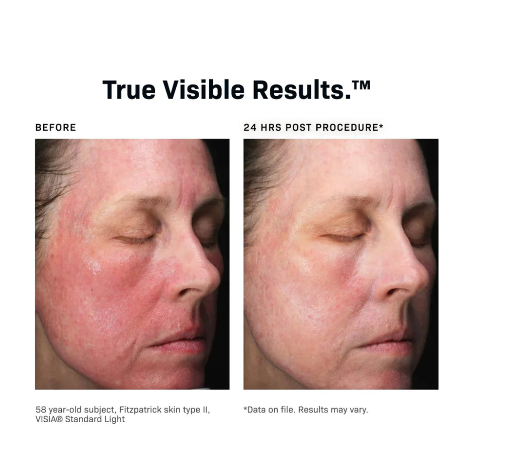 CMT Post-Procedure Cream 0.5 oz REVISION