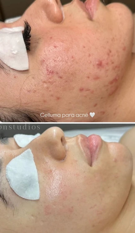 Terapia de Luz LED Celluma | Mare Perfect Skin