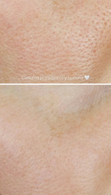Terapia de Luz LED Celluma | Mare Perfect Skin