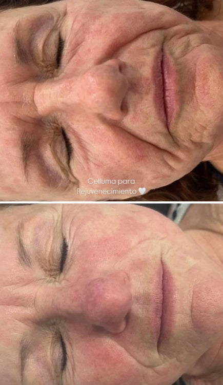 Terapia de Luz LED Celluma | Mare Perfect Skin