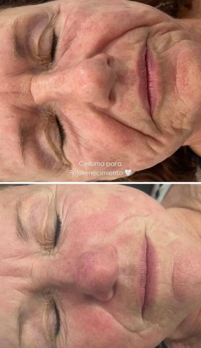 Terapia de Luz LED Celluma | Mare Perfect Skin