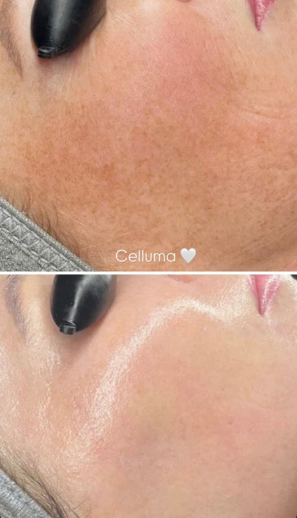 Terapia de Luz LED Celluma | Mare Perfect Skin