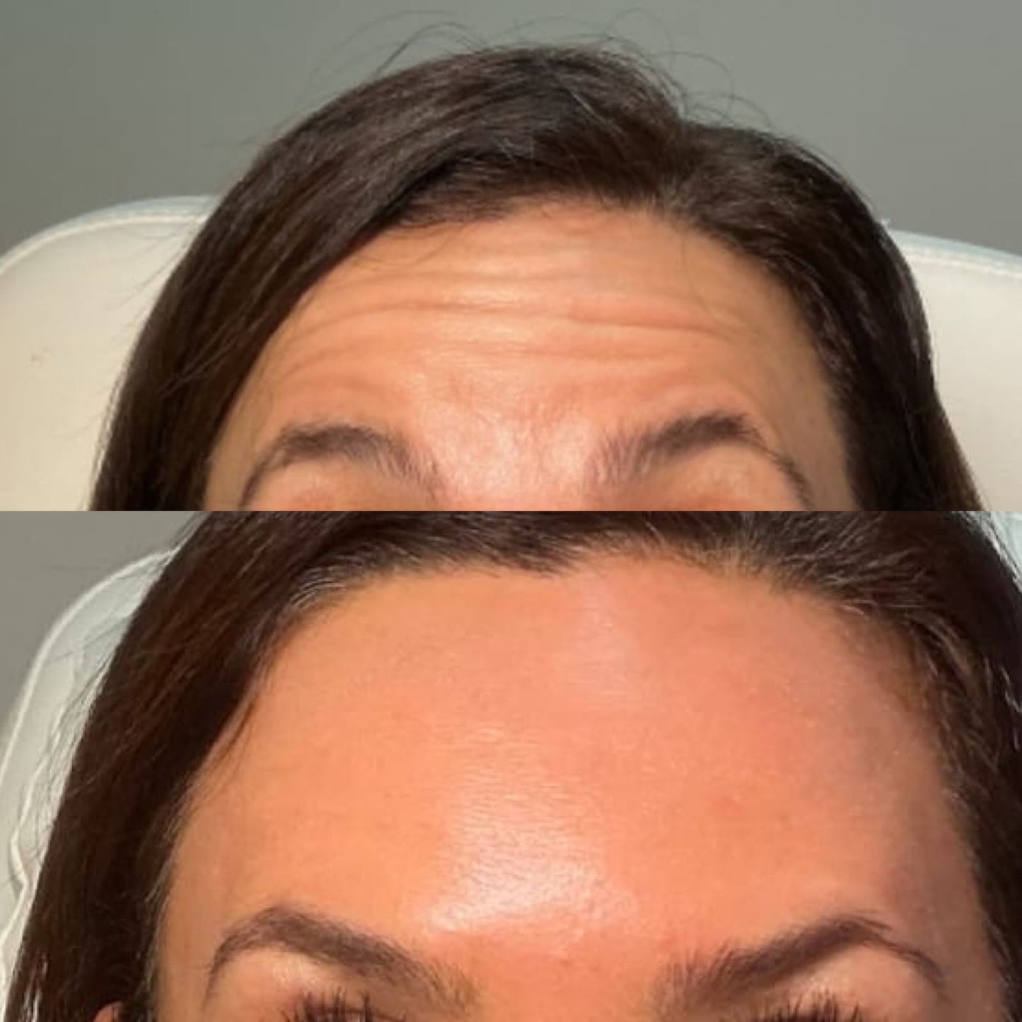 Botox Toxina Botulinica