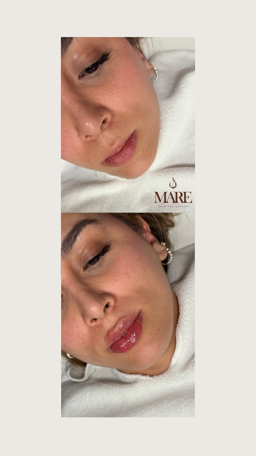 Rellenos con acido Hialuronico