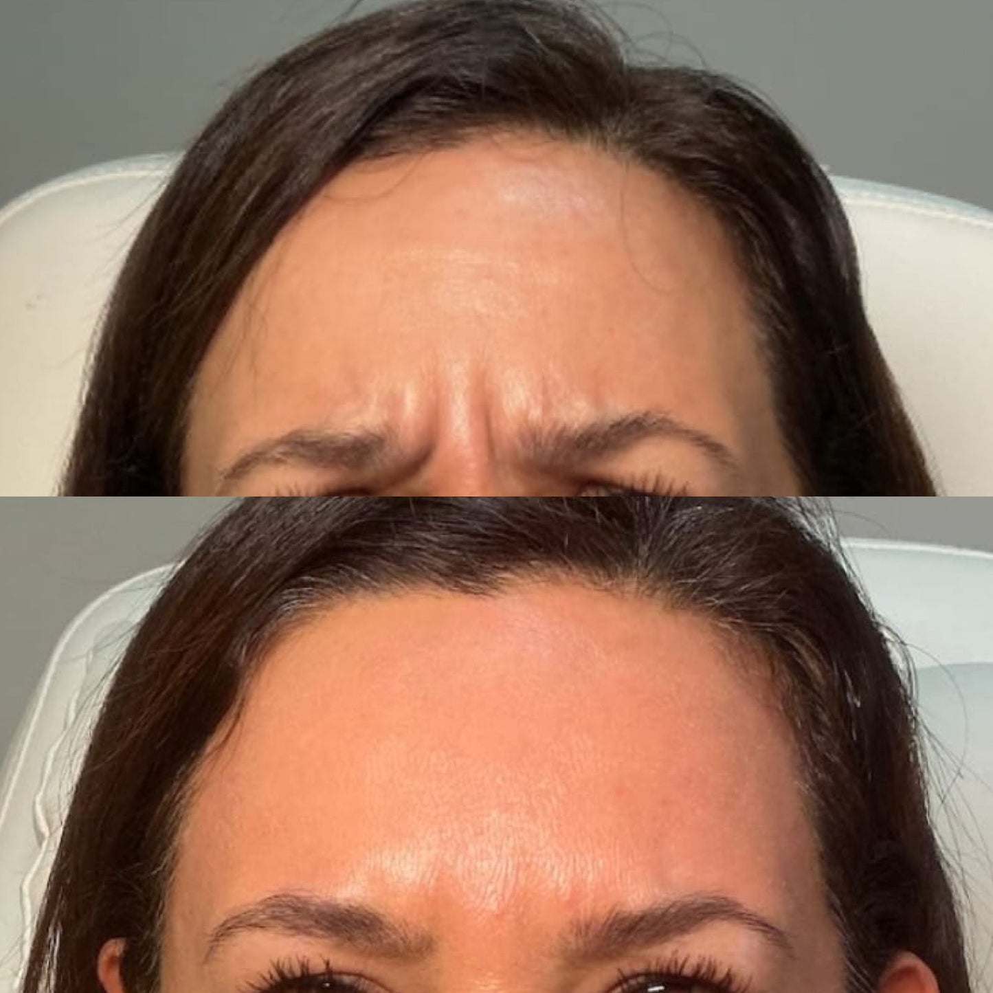 Botox Toxina Botulinica