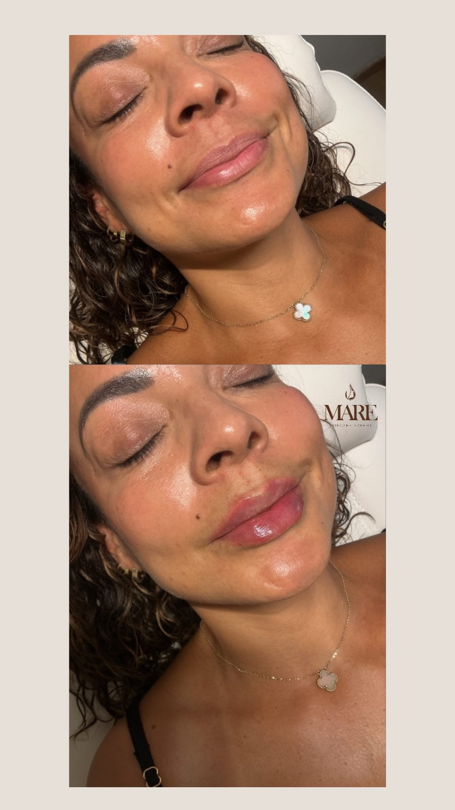 Rellenos con acido Hialuronico