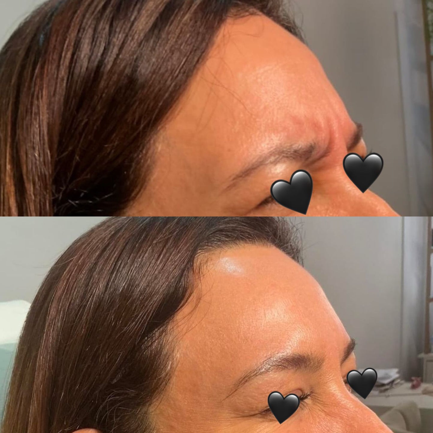 Botox Toxina Botulinica