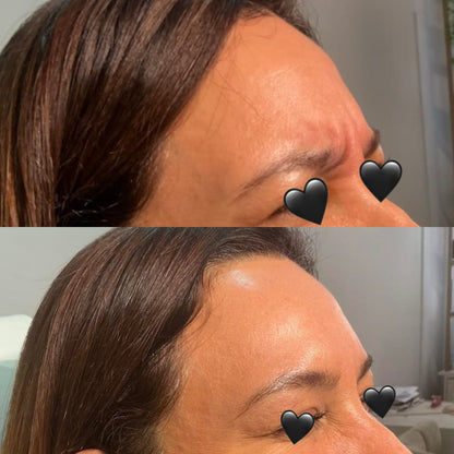 Botox Toxina Botulinica