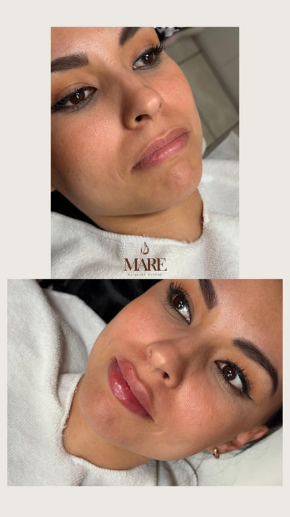 Rellenos con acido Hialuronico