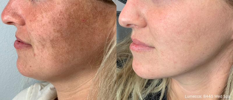 Lumecca IPL – Rejuvenecimiento Facial